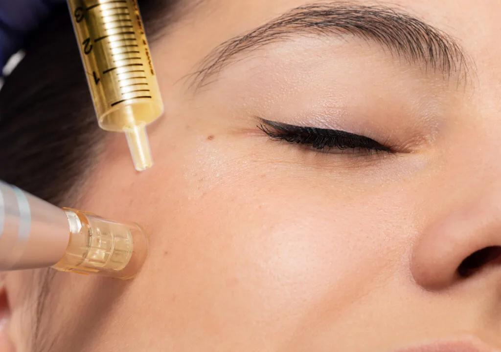 Microneedling with PRP