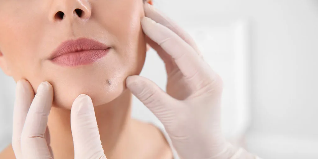 Mole Removal